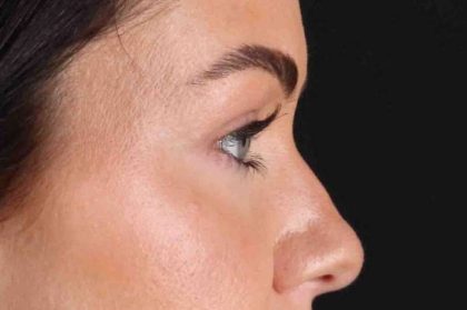 Blepharoplasty (Eyelid Surgery) Before & After Patient #4503