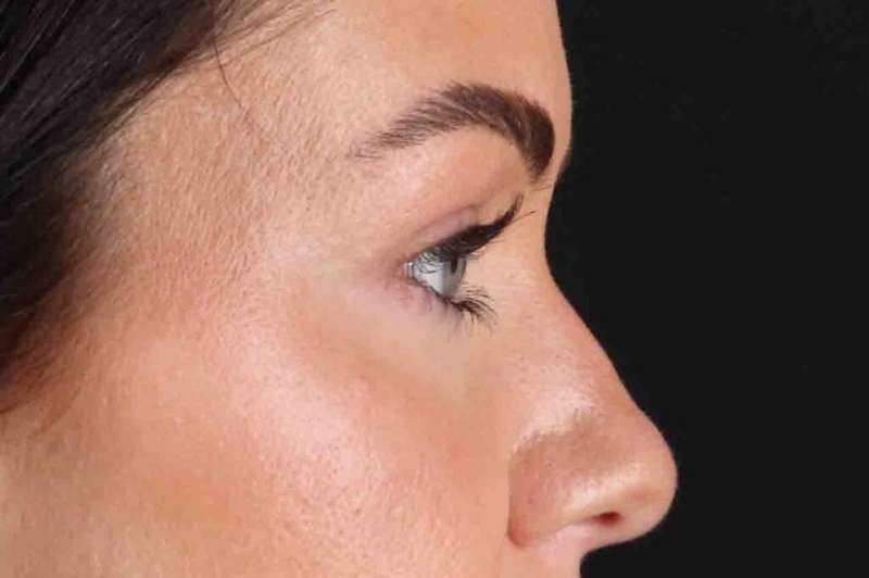 Blepharoplasty (Eyelid Surgery) Before & After Patient #4503