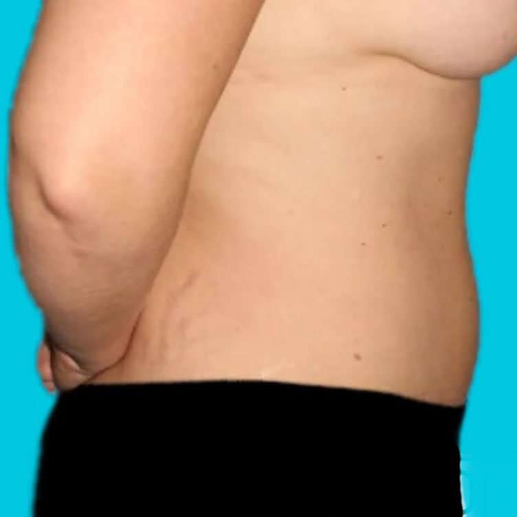 Abdominoplasty (Tummy Tuck) Before & After Patient #936