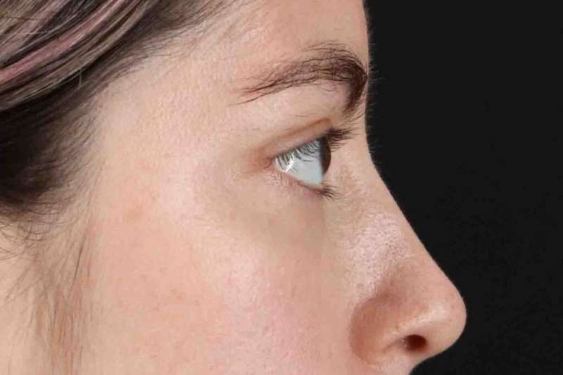 Blepharoplasty (Eyelid Surgery) Before & After Patient #4514