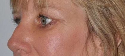 Blepharoplasty (Eyelid Surgery) Before & After Patient #4546