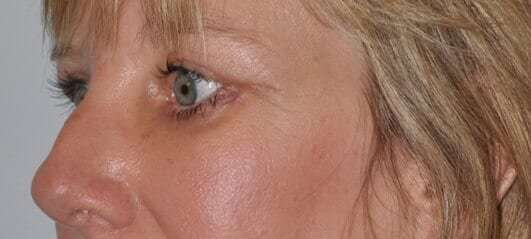 Blepharoplasty (Eyelid Surgery) Before & After Patient #4546