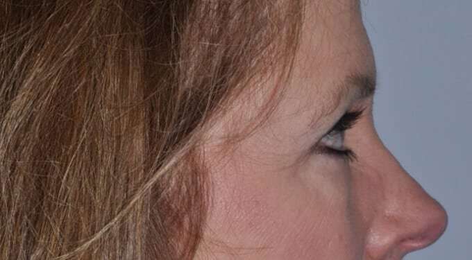 Blepharoplasty (Eyelid Surgery) Before & After Patient #4553