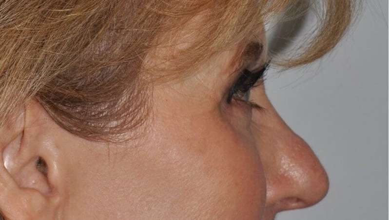 Blepharoplasty (Eyelid Surgery) Before & After Patient #4560