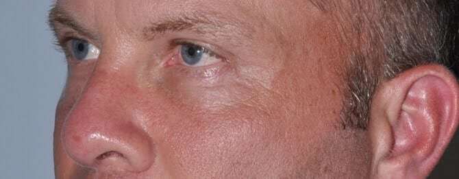 Blepharoplasty (Eyelid Surgery) Before & After Patient #4574