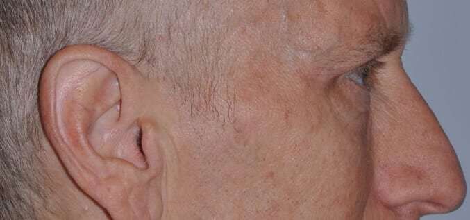 Blepharoplasty (Eyelid Surgery) Before & After Patient #4581