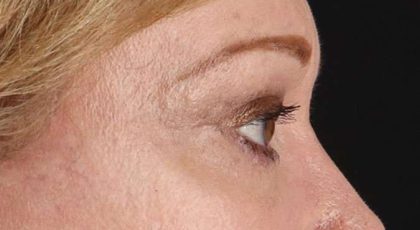 Blepharoplasty (Eyelid Surgery) Before & After Patient #4588