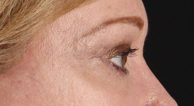 Blepharoplasty (Eyelid Surgery) Before & After Patient #4588