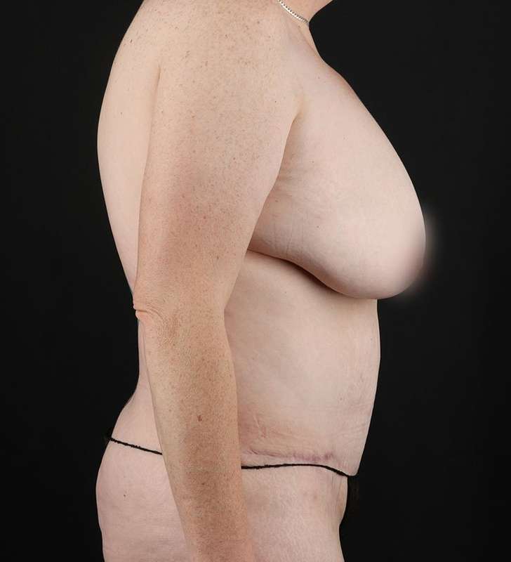 Abdominoplasty (Tummy Tuck) Before & After Patient #948