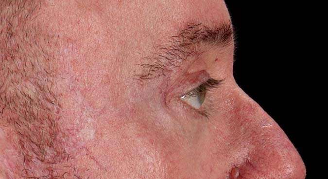 Blepharoplasty (Eyelid Surgery) Before & After Patient #4599