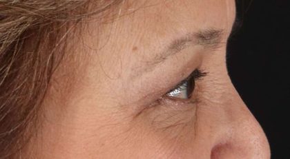 Blepharoplasty (Eyelid Surgery) Before & After Patient #4649