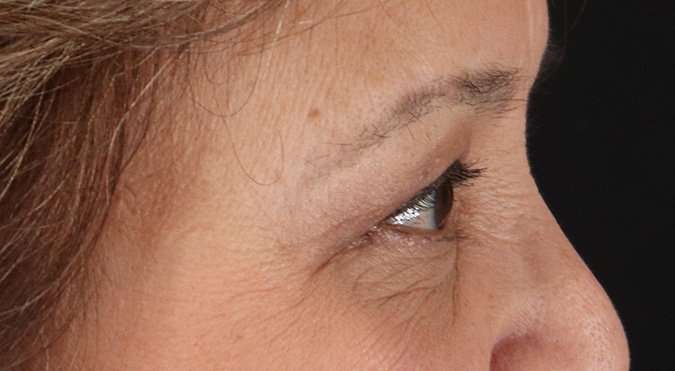 Blepharoplasty (Eyelid Surgery) Before & After Patient #4649