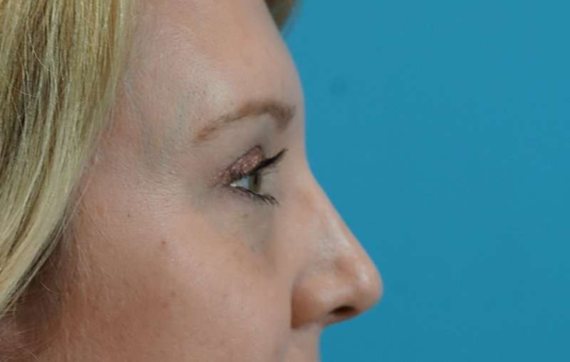 Brow Lift Before & After Patient #4672