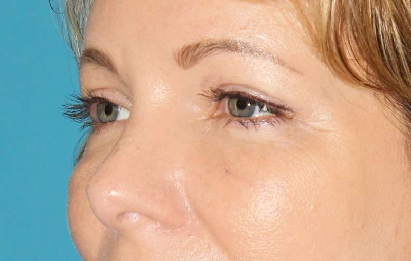 Brow Lift Before & After Patient #4679