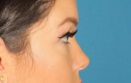 Brow Lift Before & After Patient #4690