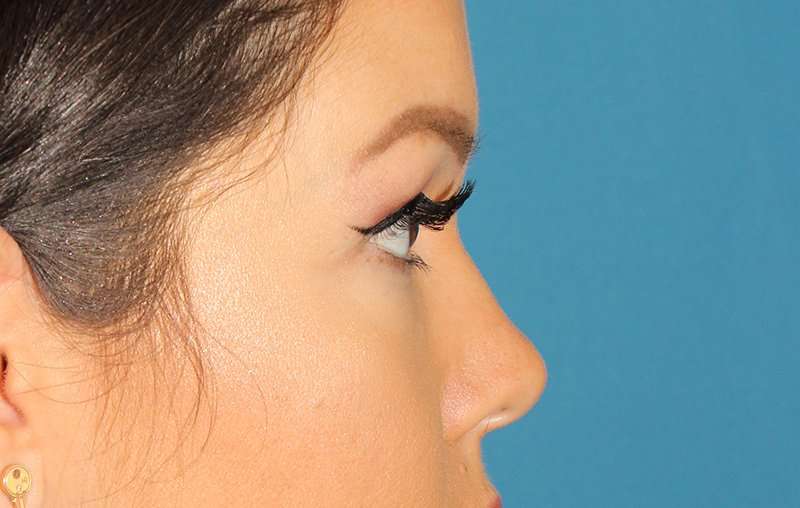 Brow Lift Before & After Patient #4690