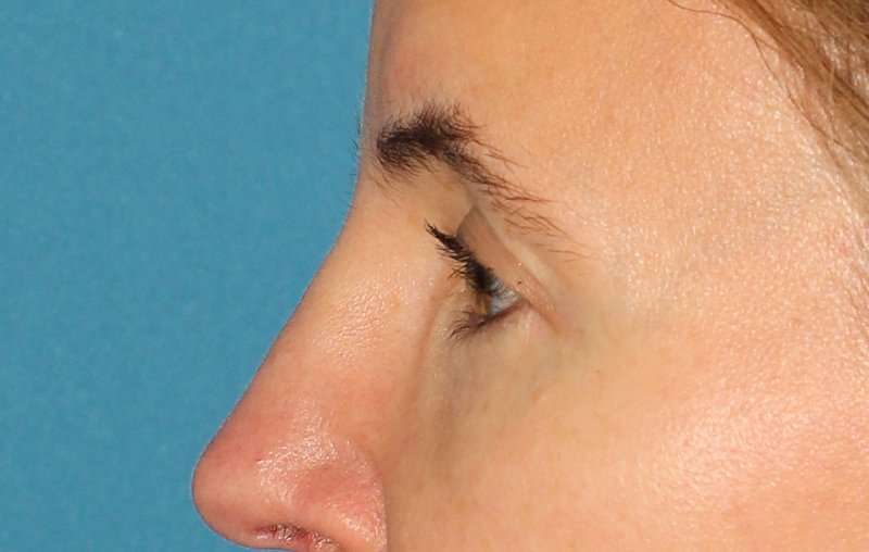 Brow Lift Before & After Patient #4697