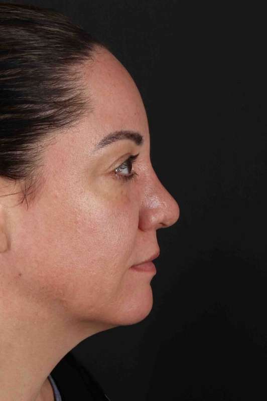 Brow Lift Before & After Patient #4733