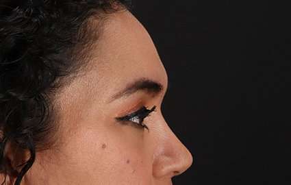 Brow Lift Before & After Patient #4744