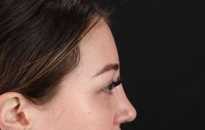 Brow Lift Before & After Patient #4766