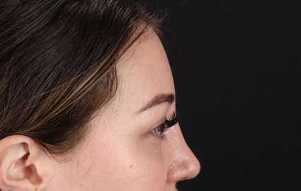 Brow Lift Before & After Patient #4766