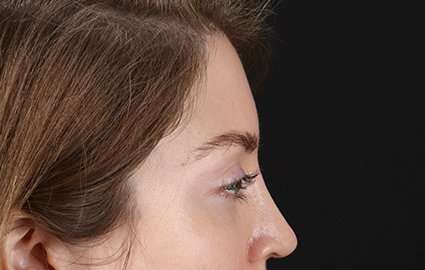 Brow Lift Before & After Patient #4777