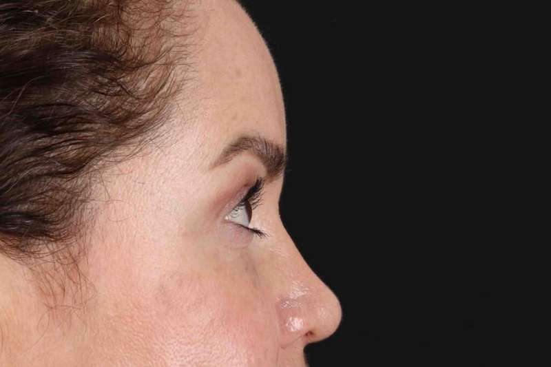 Brow Lift Before & After Patient #4843