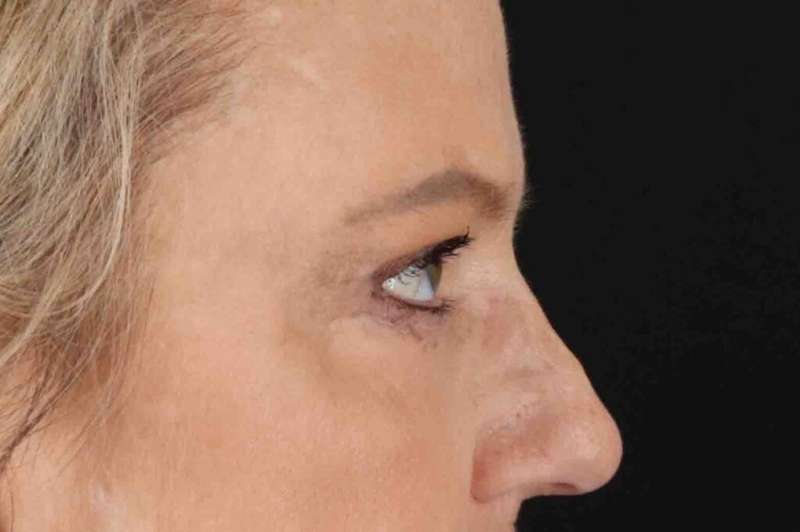 Brow Lift Before & After Patient #4854
