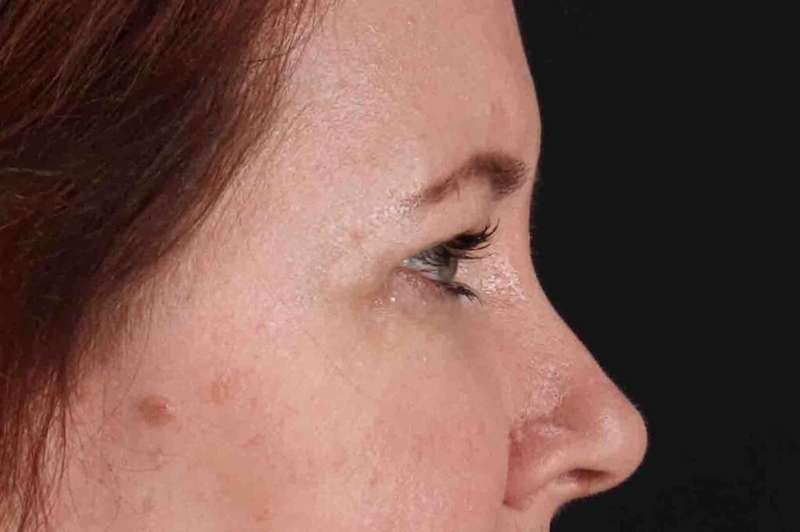 Brow Lift Before & After Patient #4865