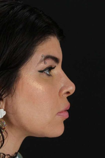 Brow Lift Before & After Patient #4912