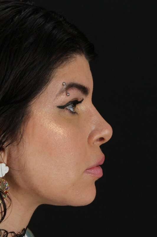 Brow Lift Before & After Patient #4912