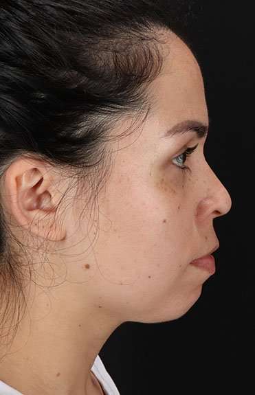 Cosmetic Injectables Before & After Patient #4990
