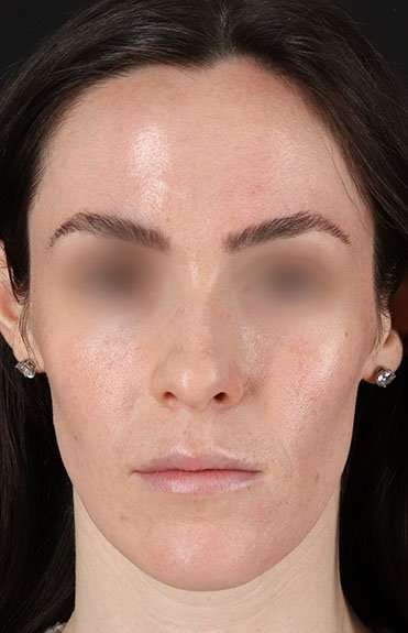 Cosmetic Injectables Before & After Patient #5016