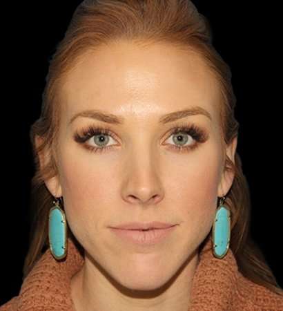 Cosmetic Injectables Before & After Patient #5026