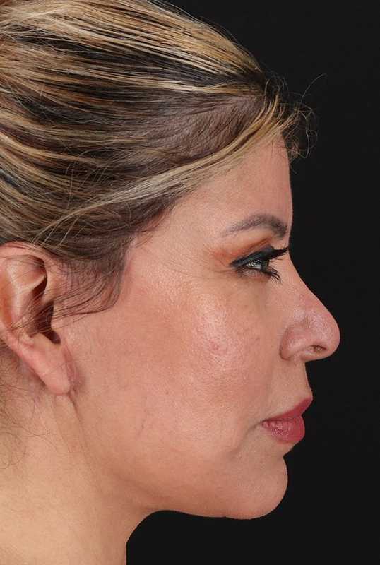 Earlobe Repair Before & After Patient #5064