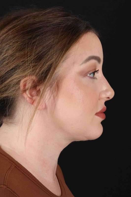 Facelift Before & After Patient #5097