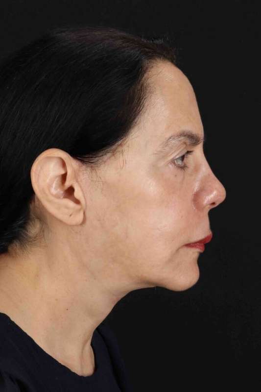 Facelift Before & After Patient #5141