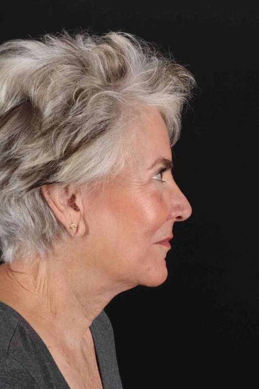 Facelift Before & After Patient #5152