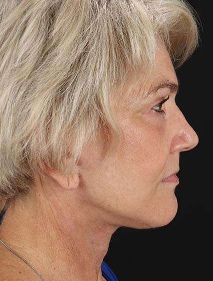 Facelift Before & After Patient #5163