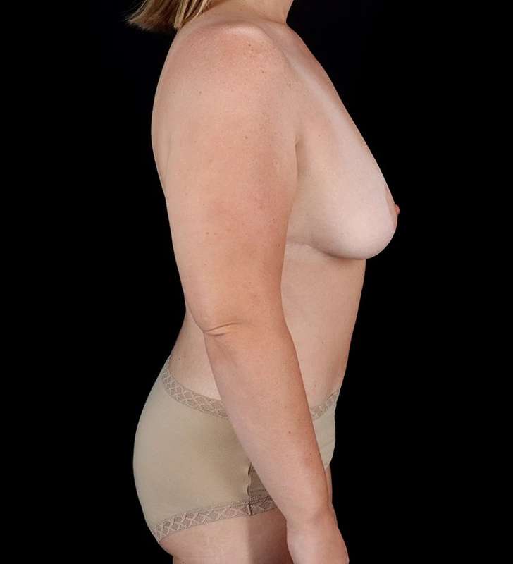 Abdominoplasty (Tummy Tuck) Before & After Patient #1001