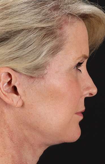 Facelift Before & After Patient #5229