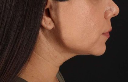 Facelift Before & After Patient #5251