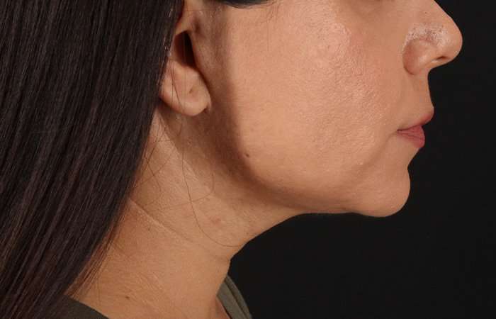 Facelift Before & After Patient #5251