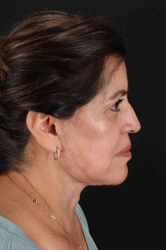 Facelift Before & After Patient #5284