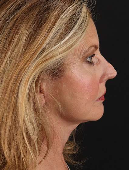 Facelift Before & After Patient #5348