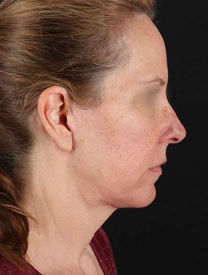 Facelift Before & After Patient #5359