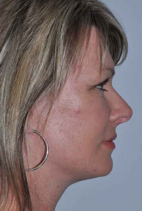 Facelift Before & After Patient #5385