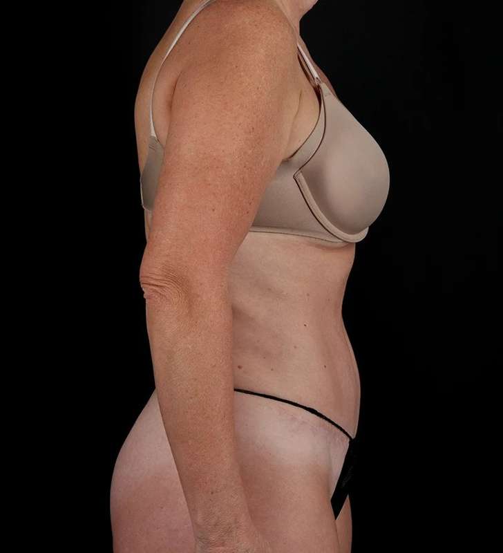 Abdominoplasty (Tummy Tuck) Before & After Patient #1029