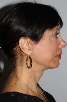 Facelift Before & After Patient #5399