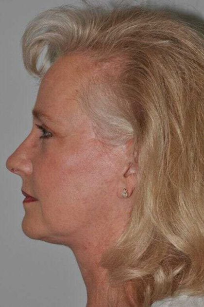 Facelift Before & After Patient #5424